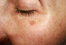 میکرونیدلینگ